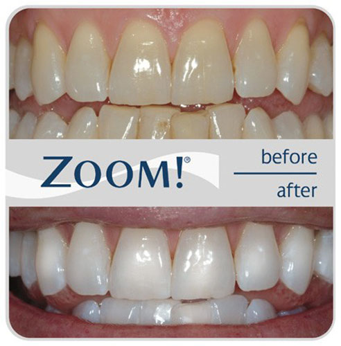 Marion cosmetic dentist | Zoom! teeth whitening | Dr. Wilson